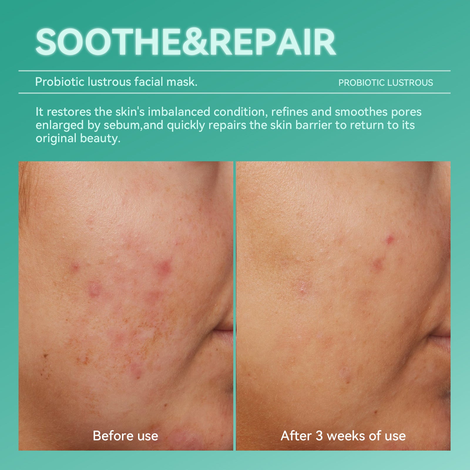 Probiotic Hydrating Mask Set for Moisturizing, Stabilizing, Repairing, Seasonal Changes, Night Recovery, and Soothing