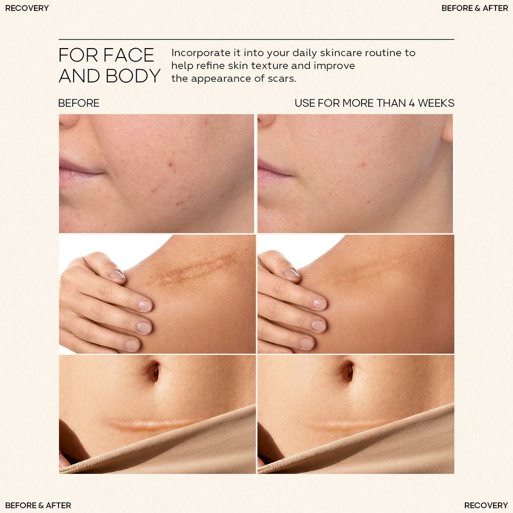 Silicone Scar Stick SILICONE SCAR STICK Acne Marks and Pits Care Lightening Cream Silicone Scar Gel