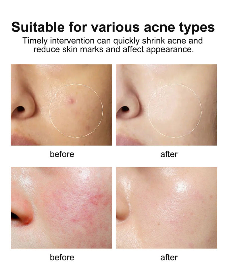 In Stock Full Salicylic Acid Acne Treatment Skin Care Essence Acne Scar Removal Pore Minimizing Toner