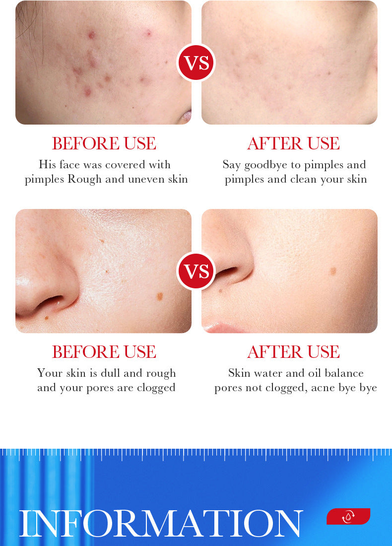 Cream BIOAOUA Salicylic Acid Moisturizing Hydrating Fading Acne Marks  Wholesale