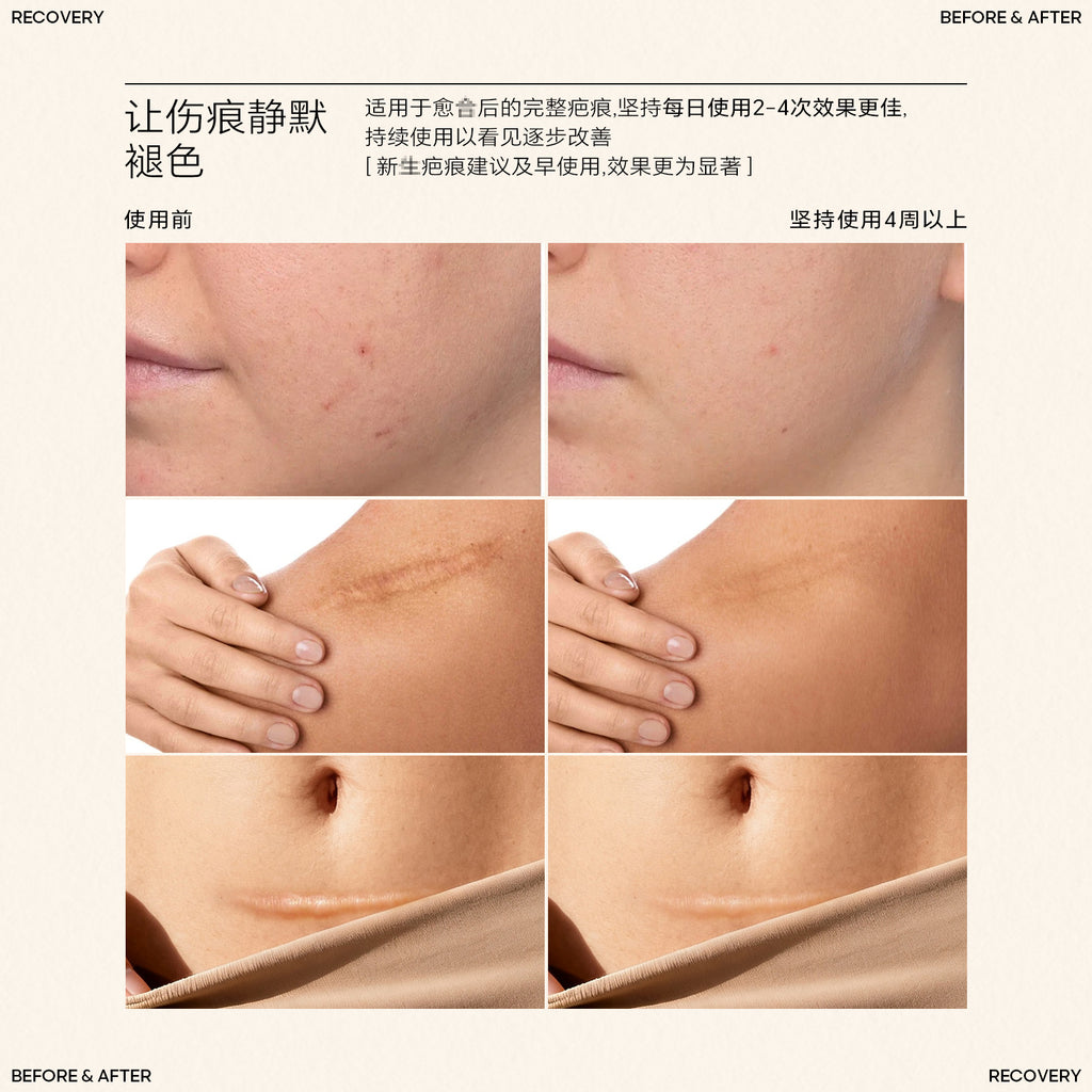 Silicone Scar Stick SILICONE SCAR STICK Acne Marks and Pits Care Lightening Cream Silicone Scar Gel
