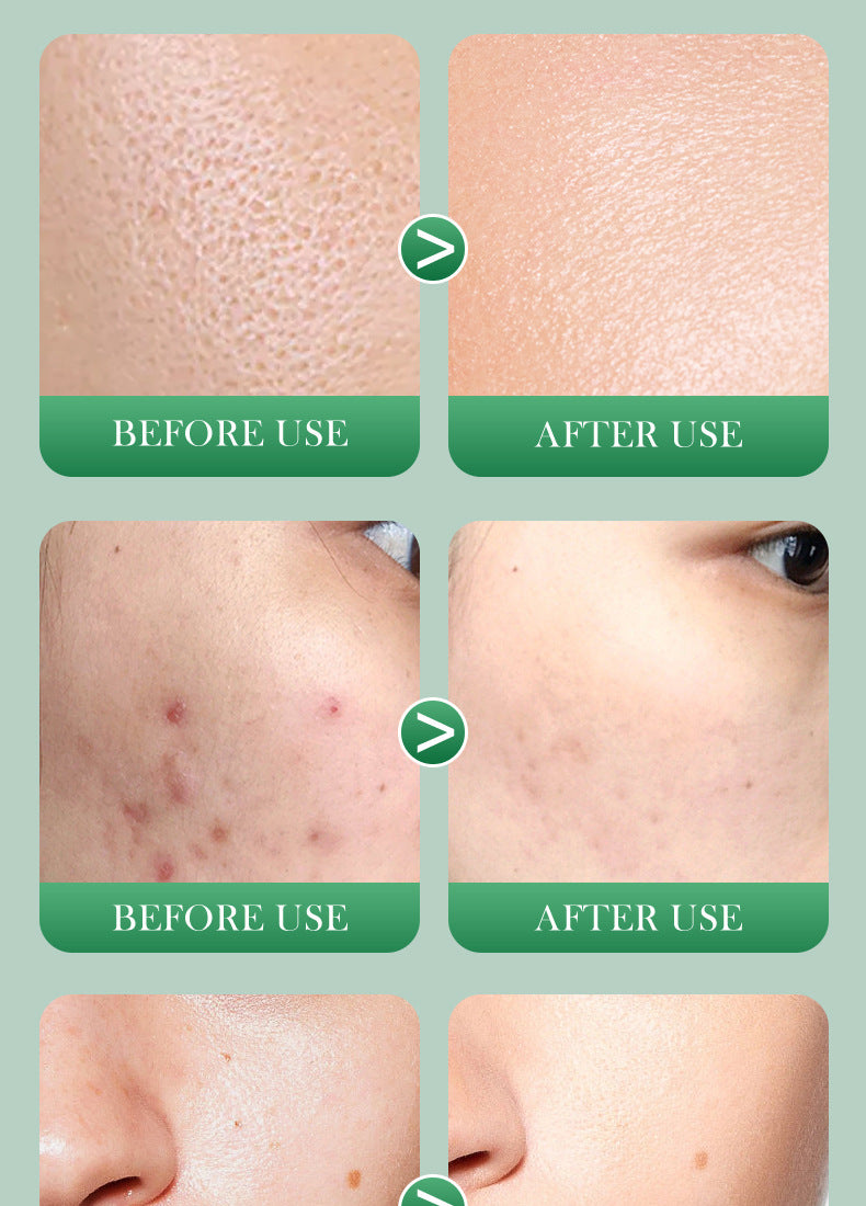 Salicylic Acid Series  BIOAOUA Pore Minimizing and Acne-Removing Mask   Factory Direct Sales