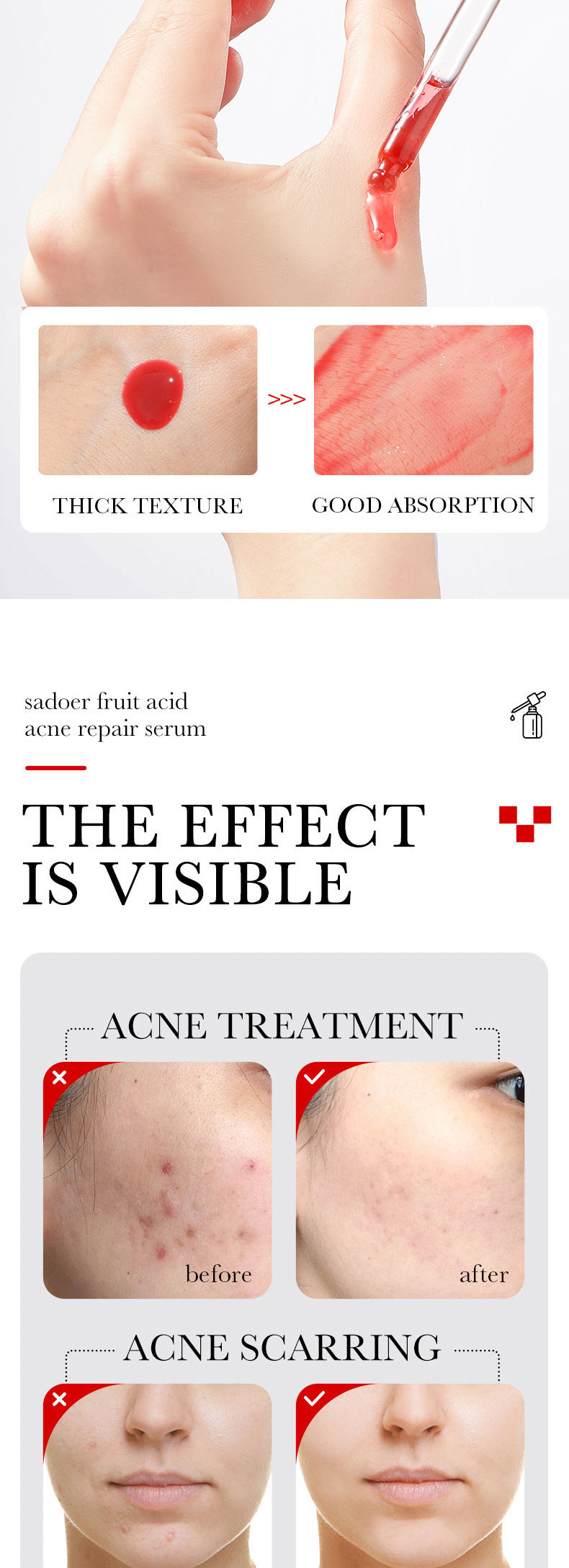 Anti-acne Serum SADOER Fruit Acid Fades Acne Marks, Hydrates and Moisturizes, Cross-Border Wholesale